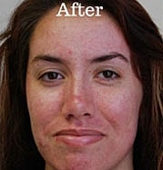 Light Therapy Before & After