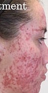 Light Therapy Before & After