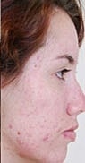 Light Therapy Before & After