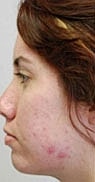 Light Therapy Before & After