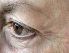 Light Therapy Before & After