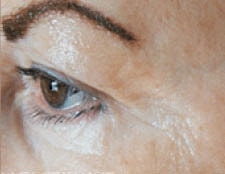 Light Therapy Before & After