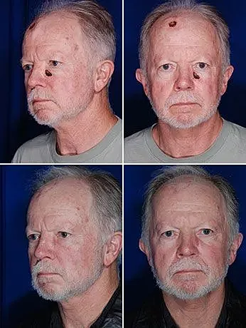 Skin cancer reconstruction before and after photos showing facial healing from multiple angles