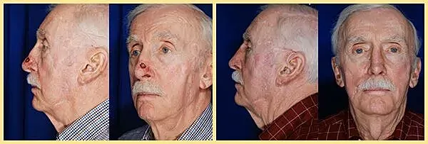 Male patient before and after skin cancer reconstruction showing facial profile and frontal views