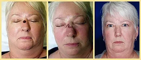 Skin cancer reconstruction patient results showing before, during, and after facial healing stages