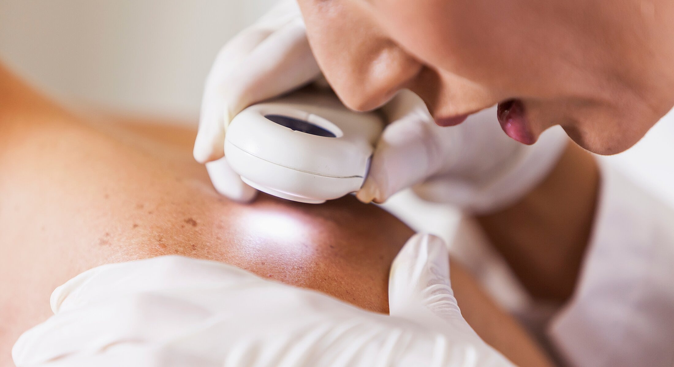 Skin examination with medical device and gloved hands.