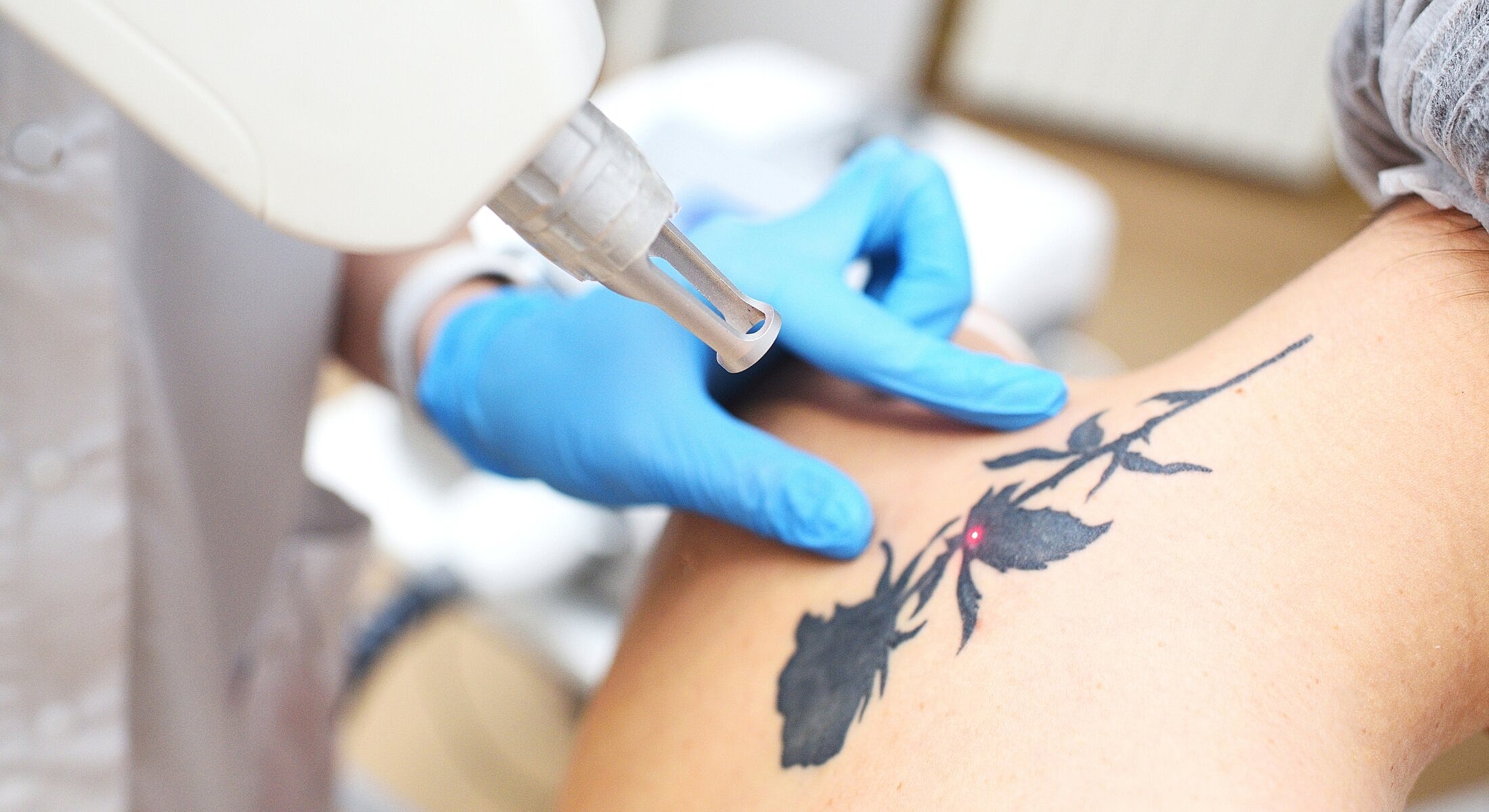 Tattoo removal in progress with laser treatment.