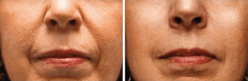 Expertise 7 Before After Photo B
