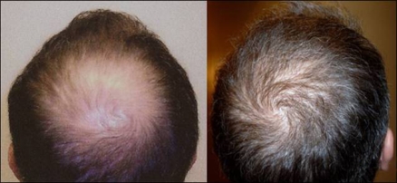 FUE hair transplant before after11