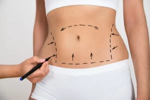 Liposuction prep and recovery
