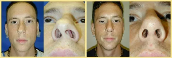 Nose Rhinoplasty patient2.2