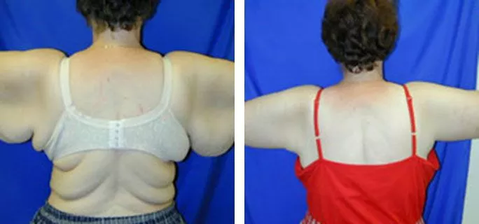 arm lift ba