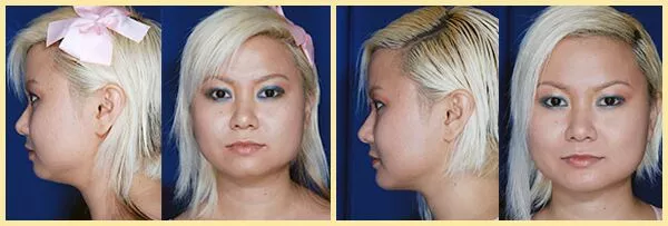 chin augmentation patient2