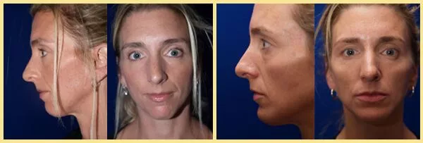 chin augmentation patient6