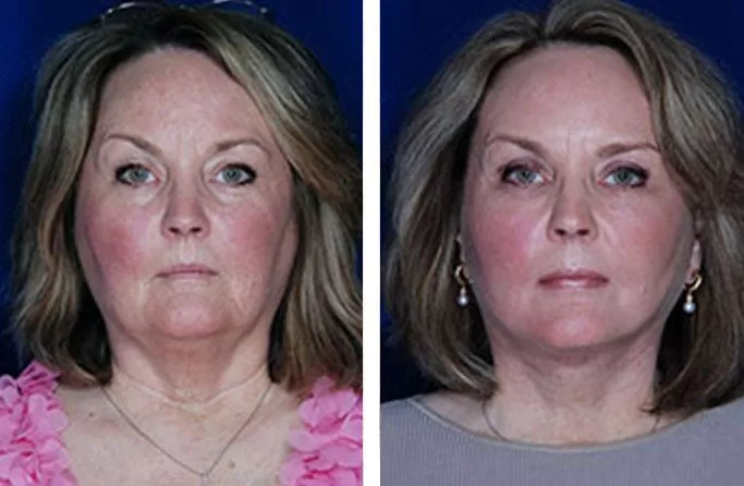 facial-fat-ba2