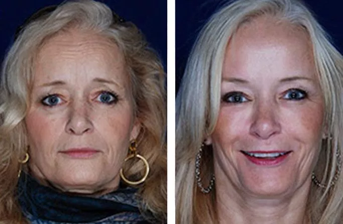 facial-fat-ba3