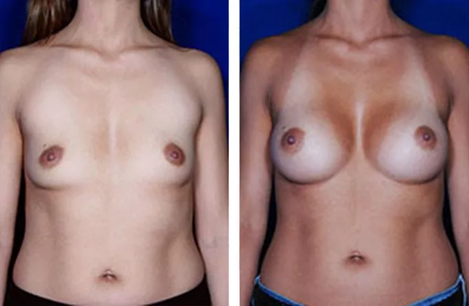 menu-breast-aug-ba3