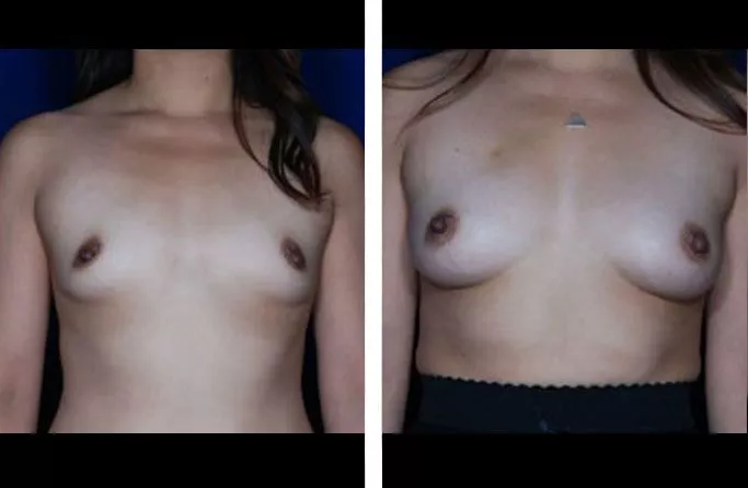 menu-breast-fat-ba2