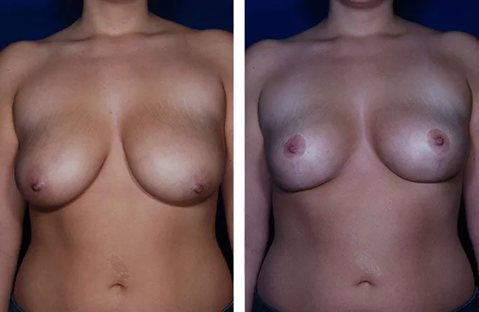 menu-breast-redux-ba