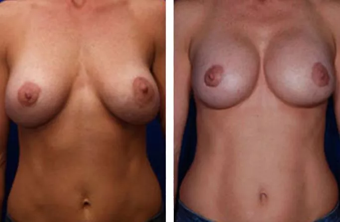 menu-breast-rev-ba2