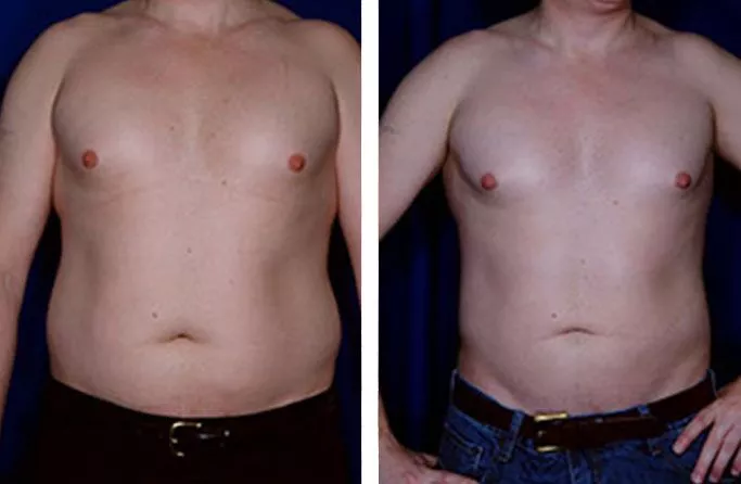 menu-male-lipo-ba
