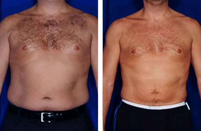 menu-male-lipo-ba2