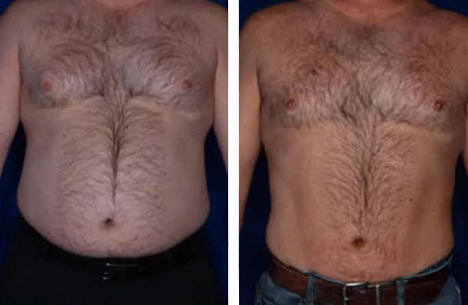 menu-male-lipo-ba3