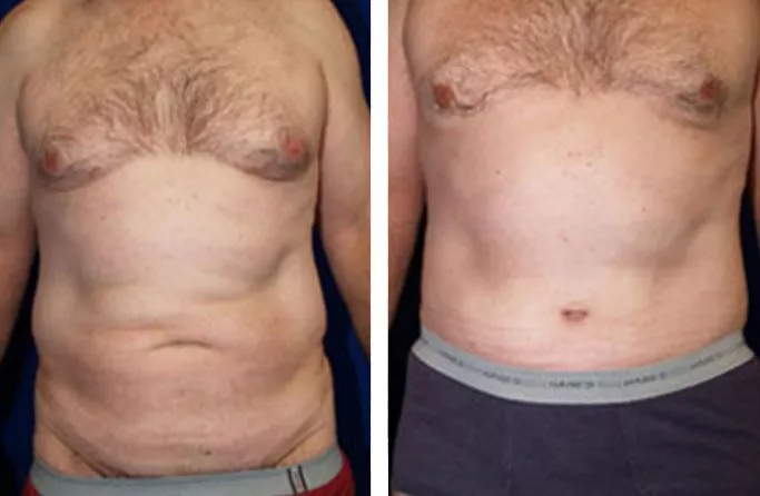 menu-male-tummy-ba2