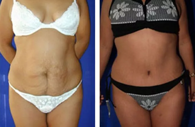 menu-tummy-tuck-ba2