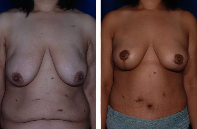 tummy-tuck-ba3