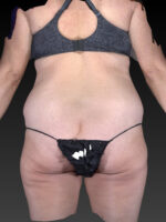 Liposuction