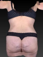 Liposuction