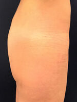 Non-Surgical Butt Lift