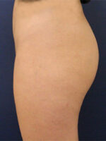 Non-Surgical Butt Lift