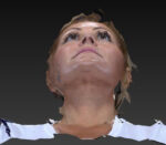 Eyelid Lift