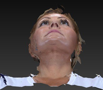 Eyelid Lift