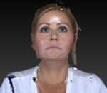 Eyelid Lift