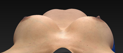 Breast Augmentation