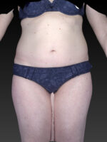 Abdominoplasty