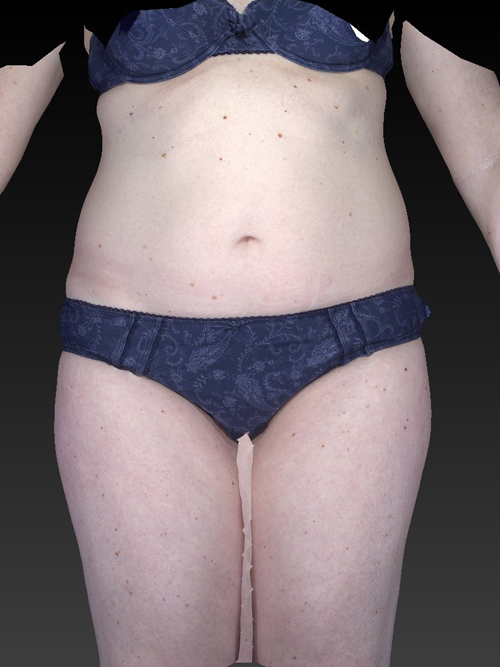 Abdominoplasty