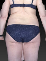 Abdominoplasty