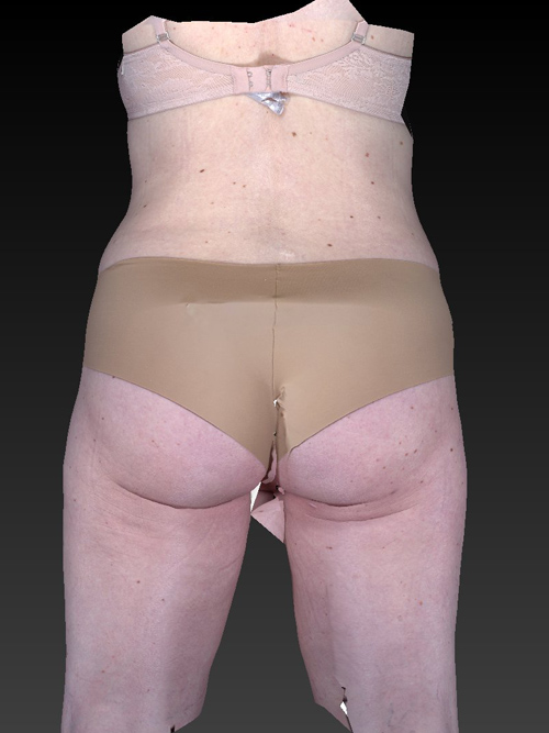 Abdominoplasty