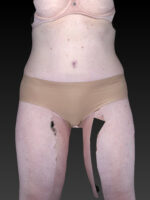 Abdominoplasty