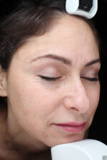Brown Spots, Wart and Scar Removal
