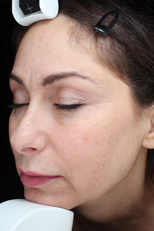 Brown Spots, Wart and Scar Removal