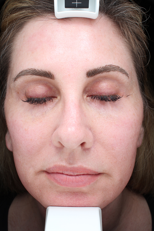 Facelift