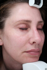 Facelift