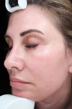 Facelift