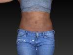 CoolSculpting