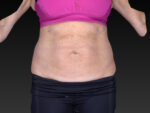 CoolSculpting